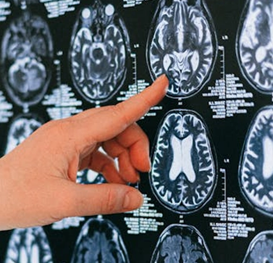 Image of brain scans being assessed
